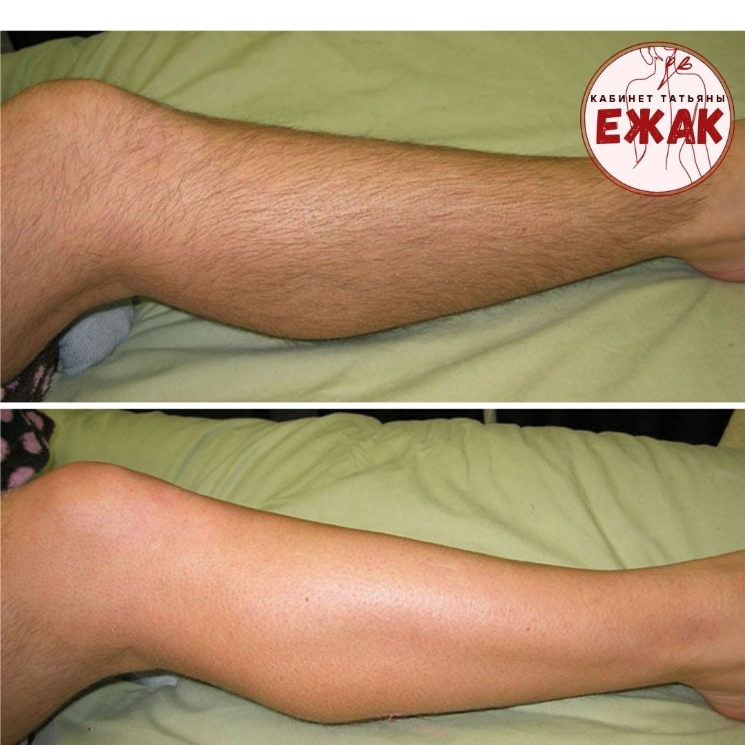 Депиляция результат 1