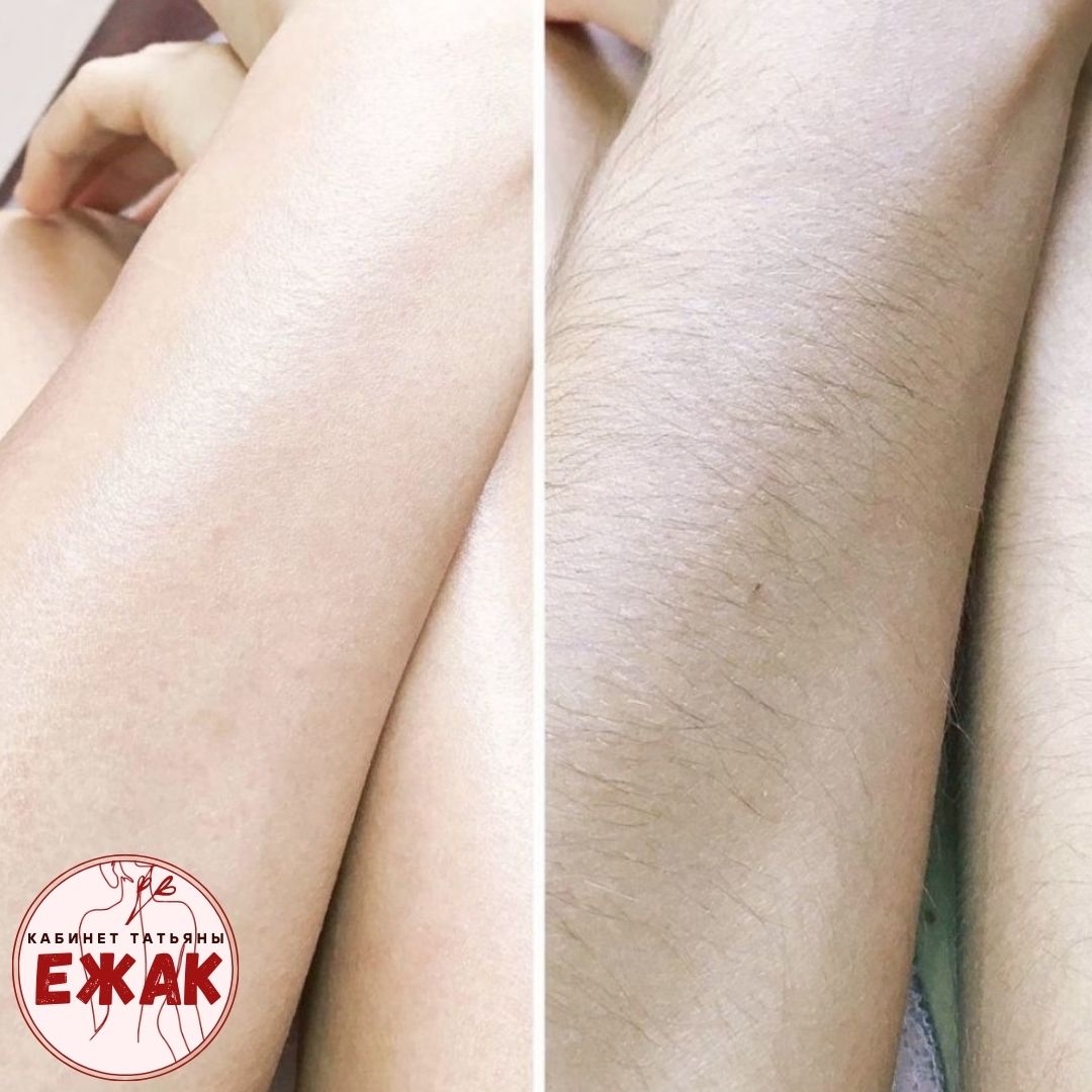 Депиляция результат 4