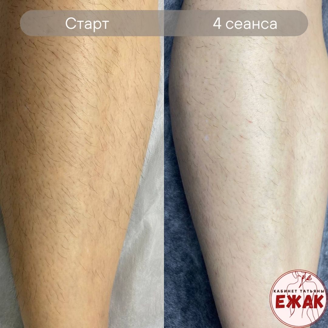Электроэпиляция результат 4