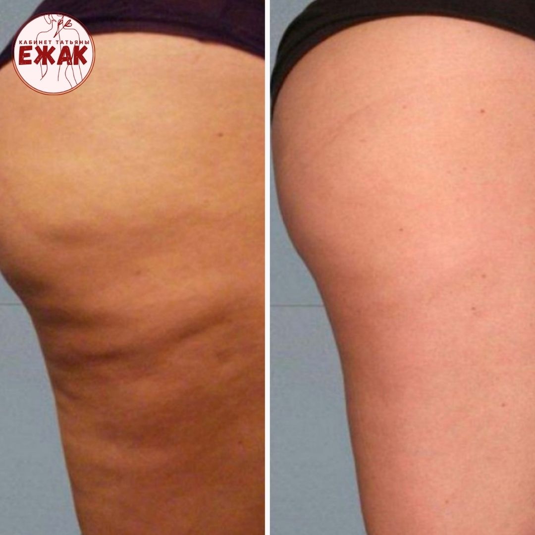 Пример работы LPG массаж 1