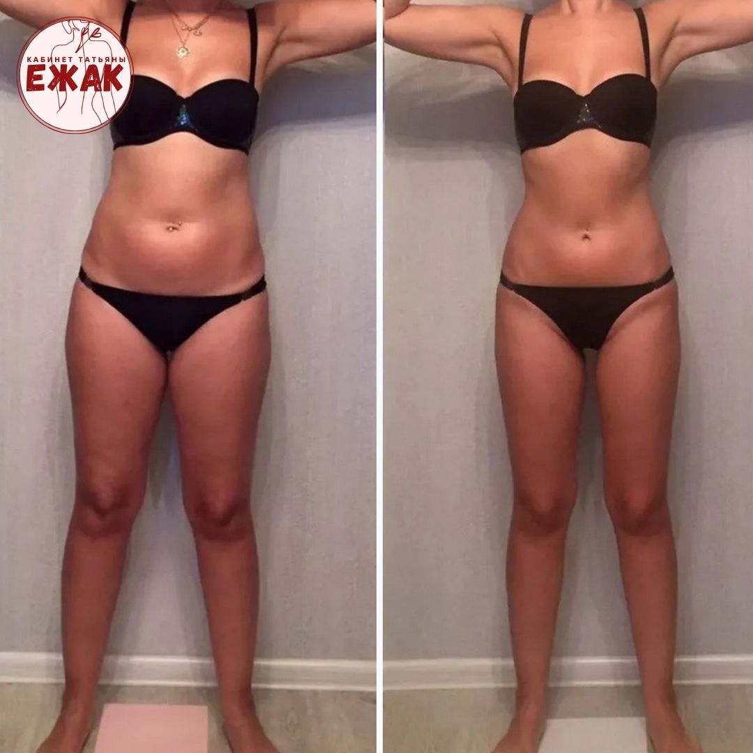 Пример работы LPG массаж 2