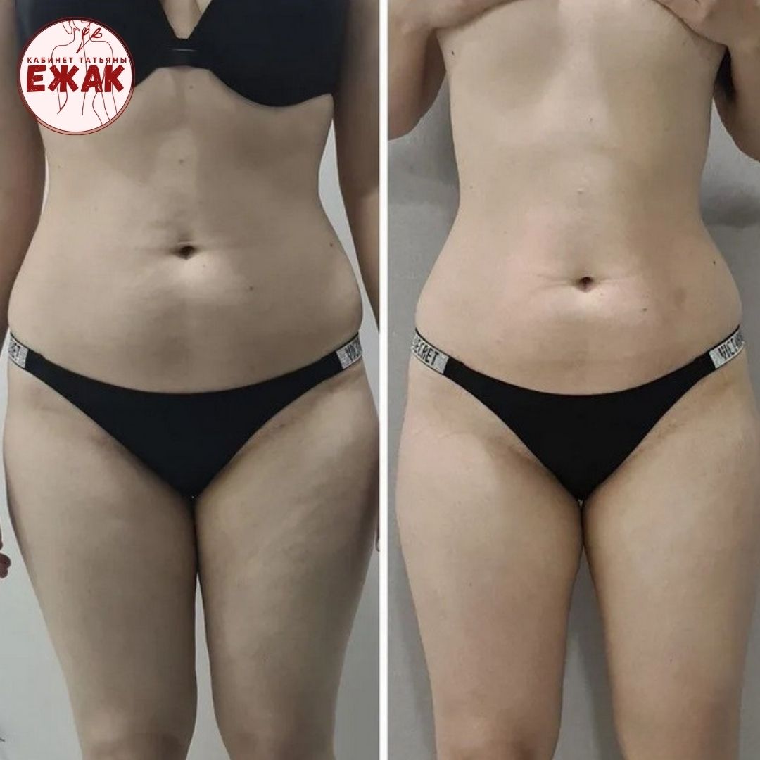 Пример работы LPG массаж 3