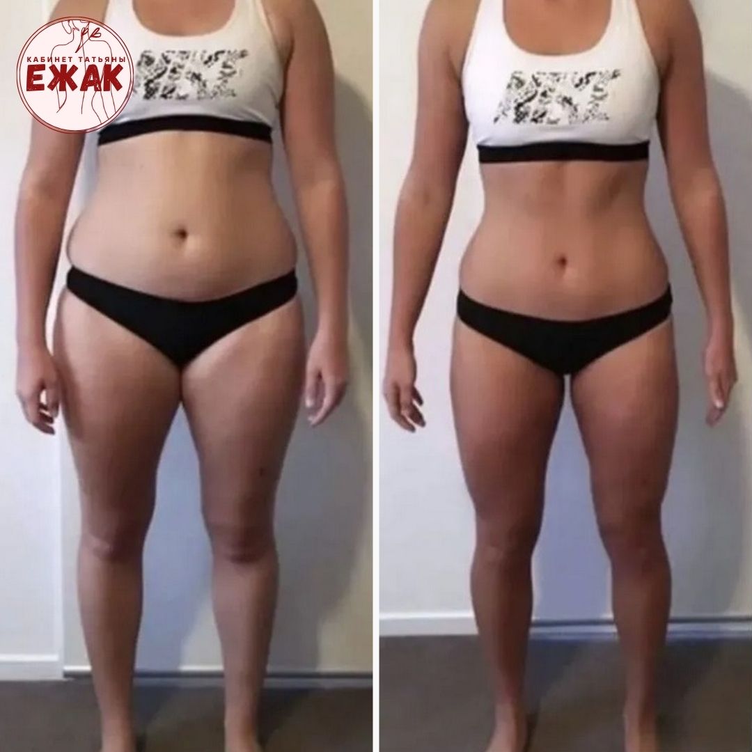 Пример работы LPG массаж 4